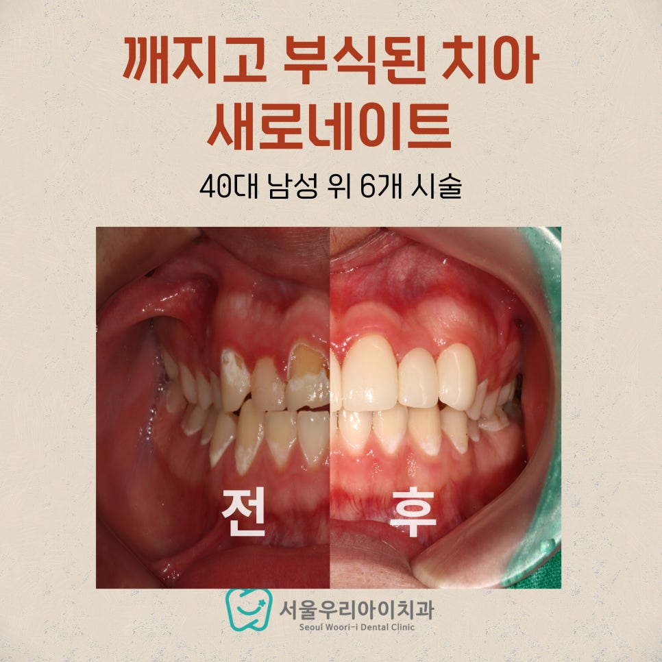 깨지고 부식된 앞니를 치료하여 환한 미소를 완성하는 광주 라미네...