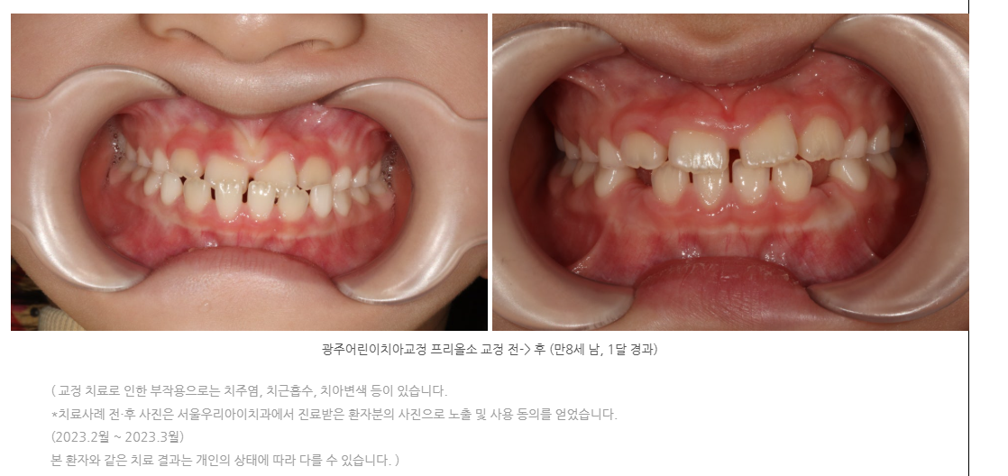 광주어린이치아교정 프리올소 교정으로 한 달만에 놀라운 변화