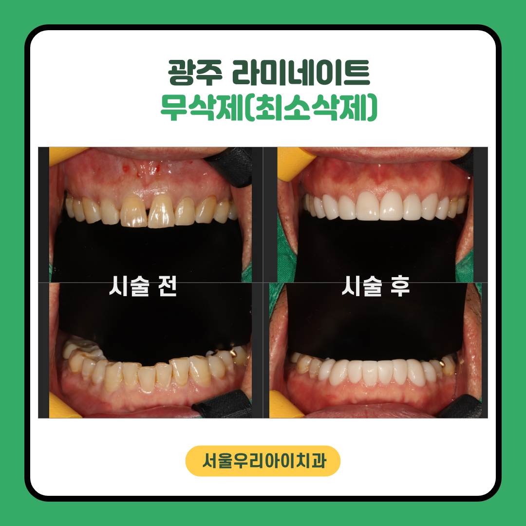 광주 라미네이트 후기가 좋은 무삭제 라미네이트 새로네이트 진료로