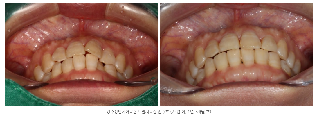 73년생 성인 여자 환자분의 광주교정치과 교정사례