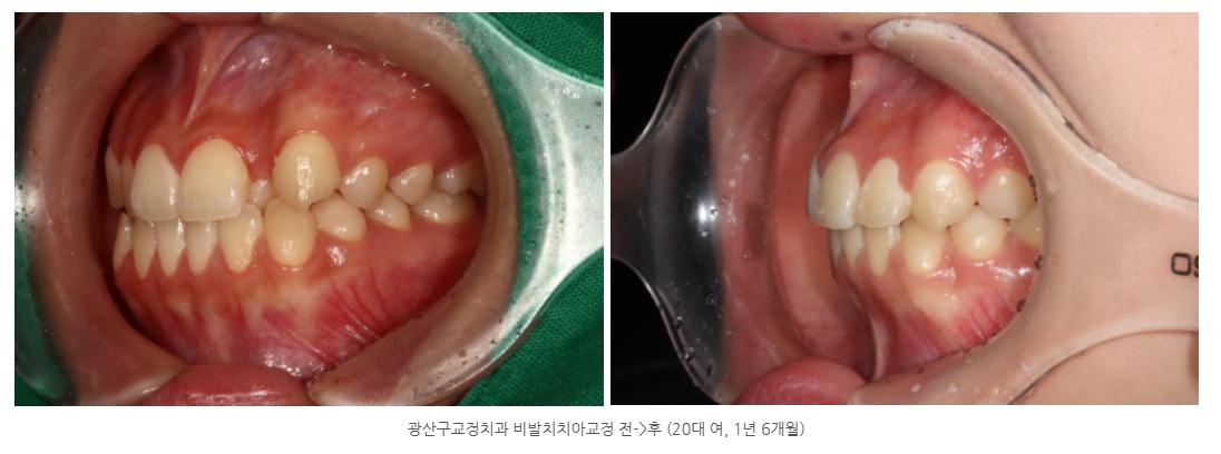 광산구에서 비발치교정 잘하는 치과는 어디일까요?