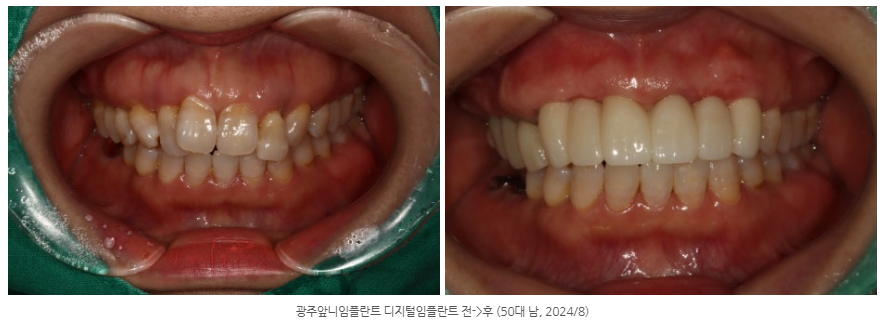 광주 틀니 사용이 싫다면 광산구 임플란트 치과에서 해결하세요!