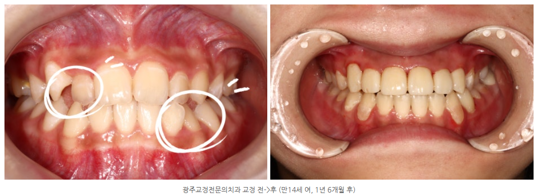 수완지구 교정치과 중에서 충치치료와 교정치료가 동시에 가능한 치...