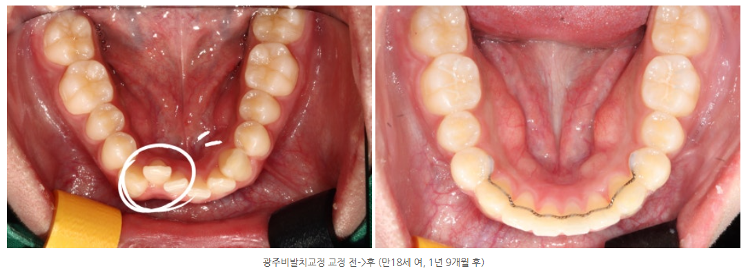 광주광역시 청소년 교정치과는 어디일까요? 이것 꼭 확인하세요!