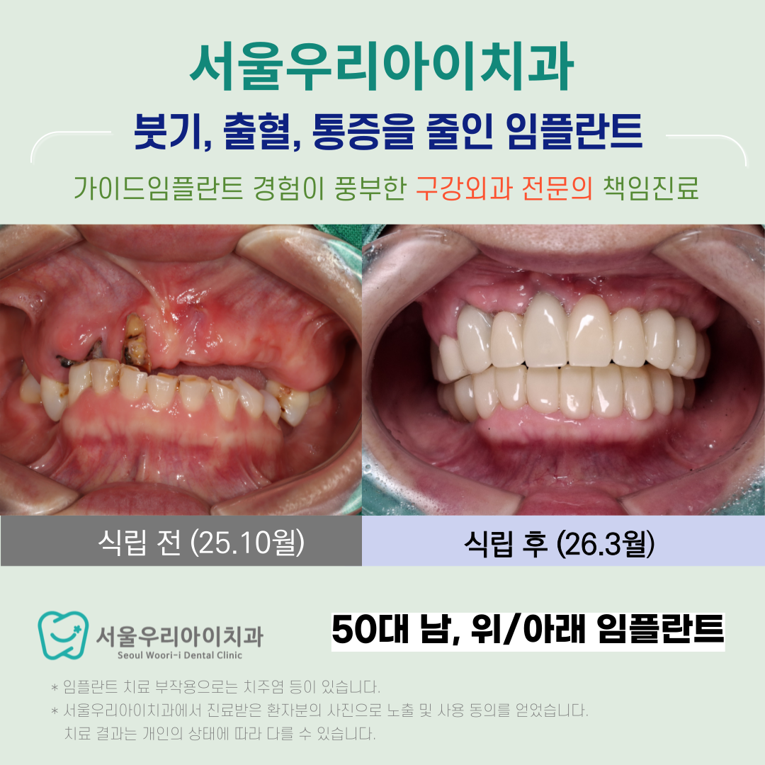 광주 전체임플란트 상악임플란트를 단 두 번의 수술로 구강외과 전...