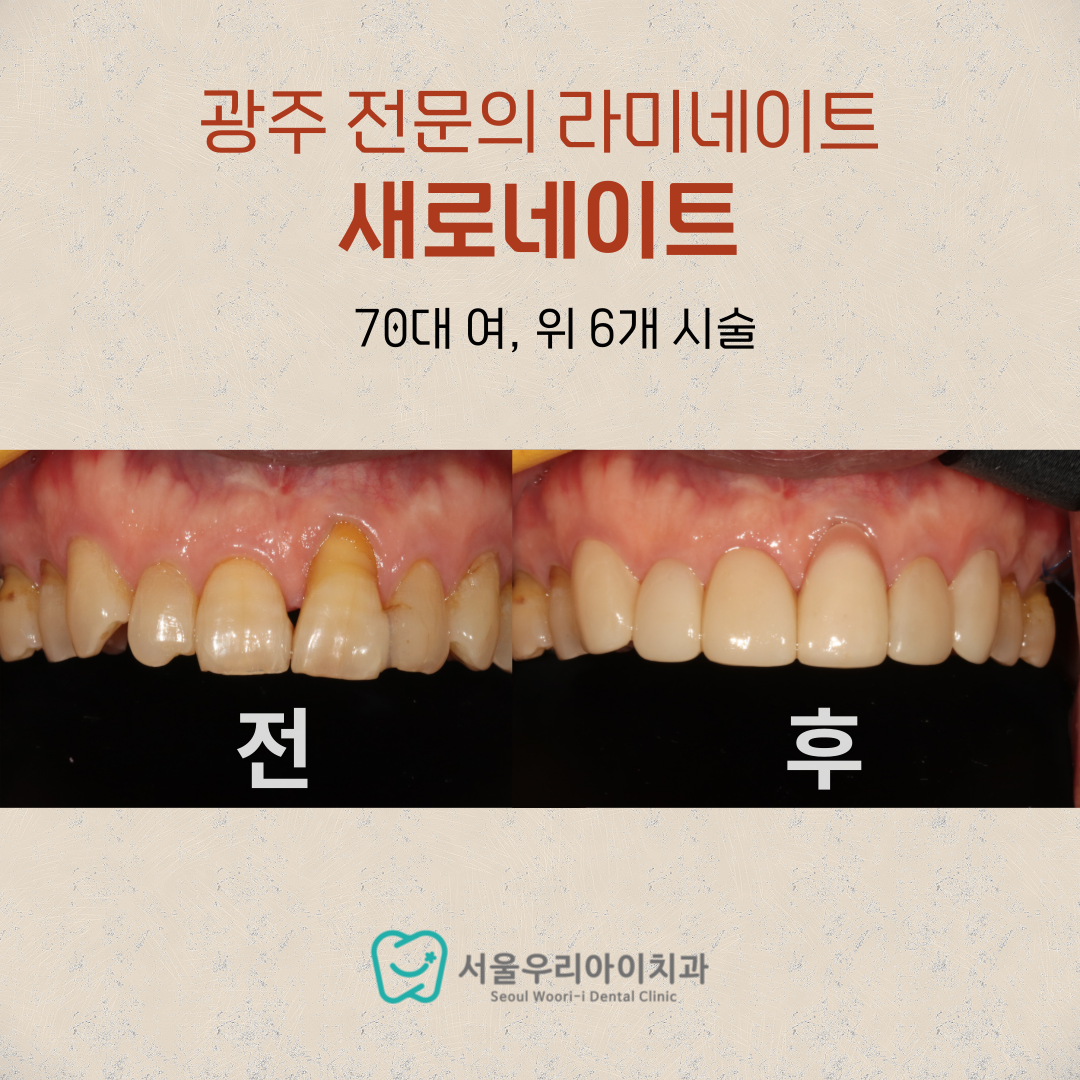 광주 라미네이트 치과 대에도 자신감 있는 비결은 바로