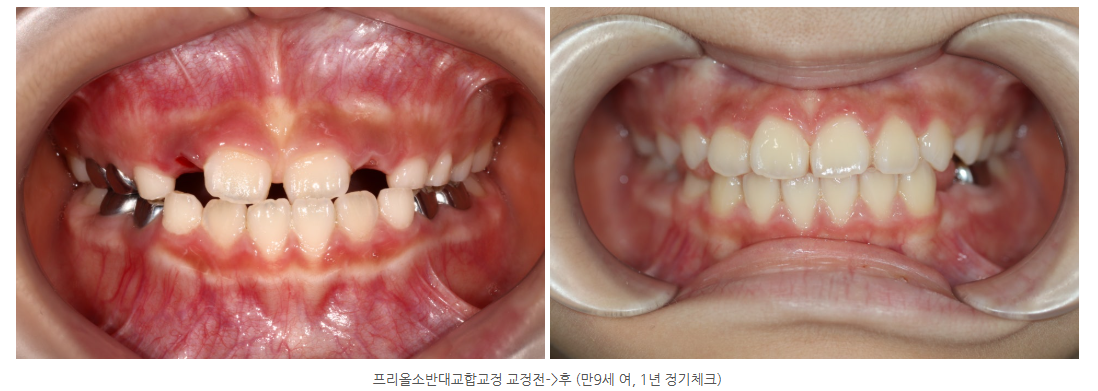 광주어린이치과 어린이치아교정 반대교합교정 후 정기검진은 언제?