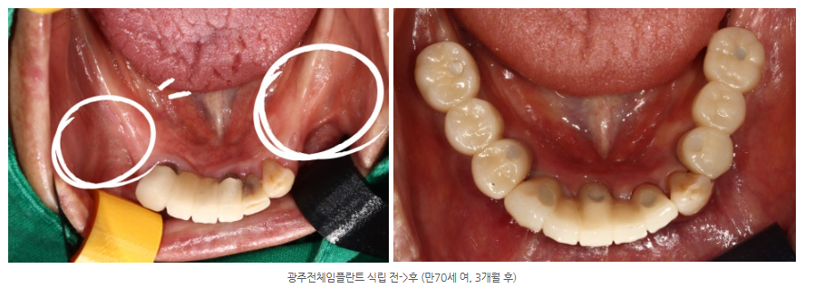 광주광역시에서 70대 환자도 임플란트가 가능한 치과가 있나요?