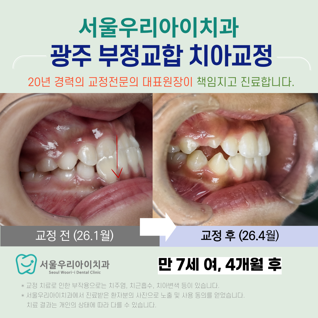 광주 부정교합 정상교합으로 바꾸기 위하여 고려해야하는 요소들은