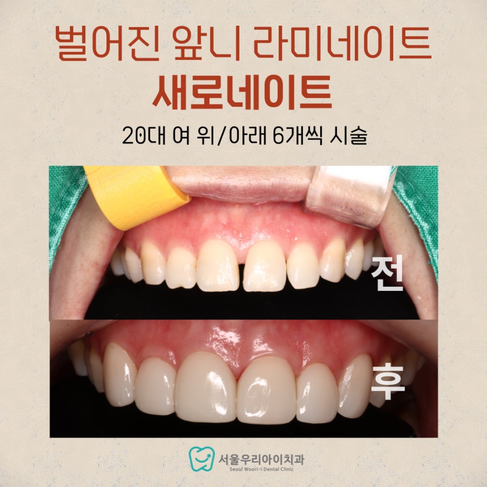 새로네이트는 벌어진 앞니를 급속으로 교정할 수 있는 라미네이트...