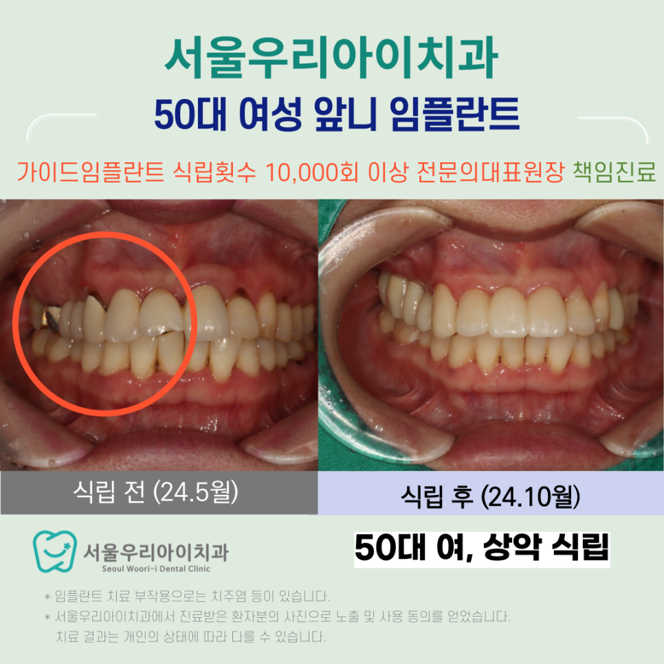 광주에서 50대 앞니 임플란트 잘하는 치과는 여기 입니다.
