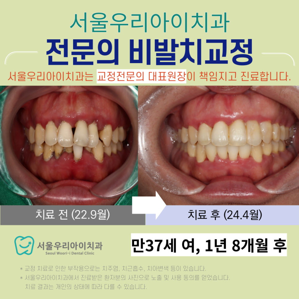 30대에도 치아교정을 할 수 있나요? 광주 30대 치아교정 후기사례