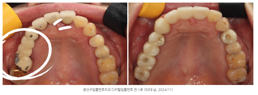 수완동 임플란트 치과에서 임플란트를 할 때 중요한 점은?