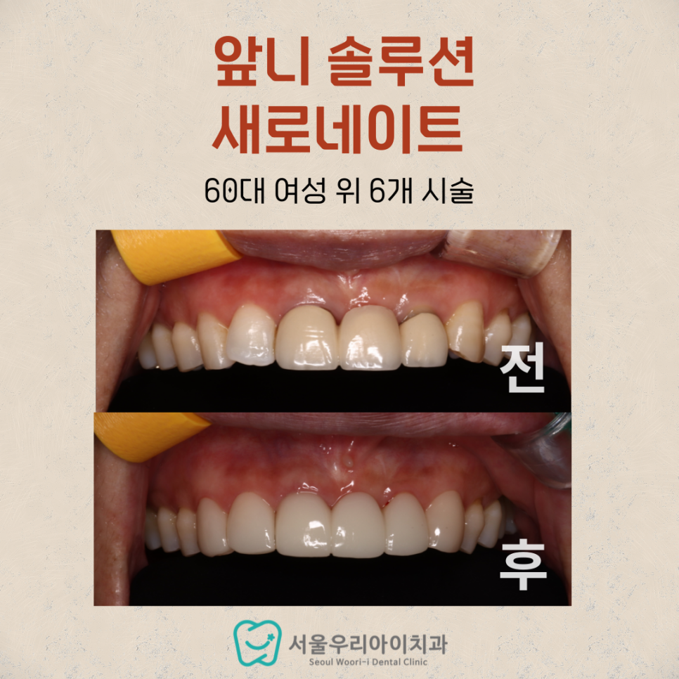 대표원장 가족도 라미네이트 진료를 하는 치과가 있다면?