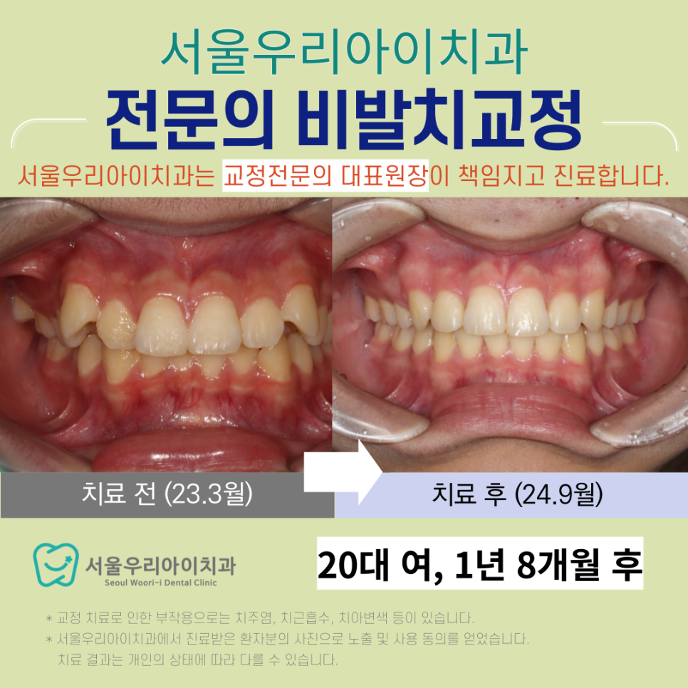광산구 비발치교정 가능한 교정치과는 어디인가요?