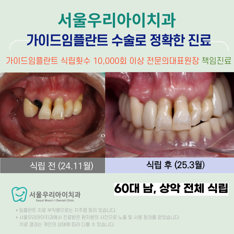 광산구 임플란트 뼈가 부족할 때는 임플란트를 어떻게 심나요?
