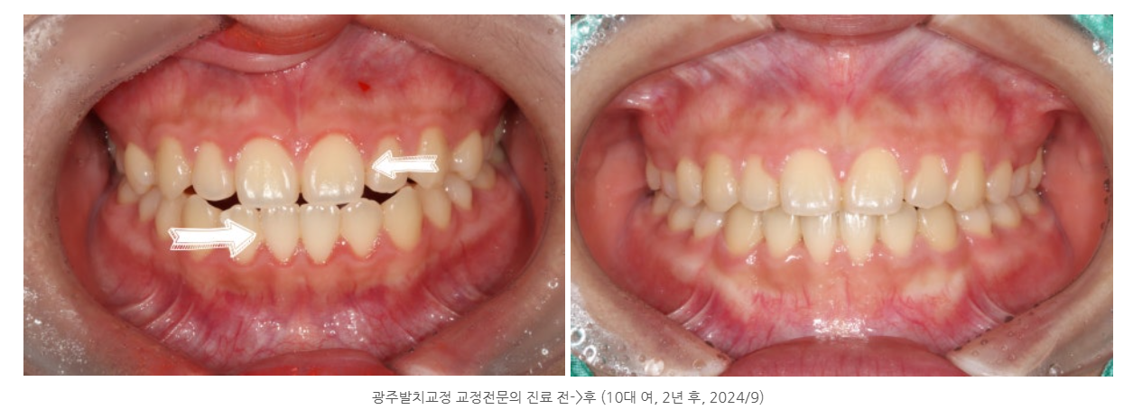 치아교정 할 때 발치 꼭 필요한가요? 광주 발치교정사례