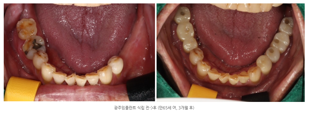 광산구 임플란트 치과에서 디지털 가이드 임플란트로 60대 환자의...