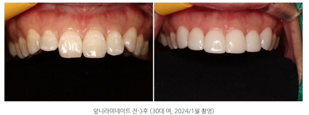 광주에서 토끼 이빨 앞니 교정 잘하는 치과를 찾는다면?