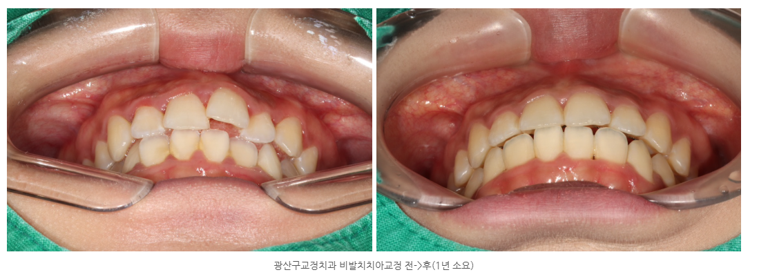 광산구교정치과 비발치교정치료 가능한가요?