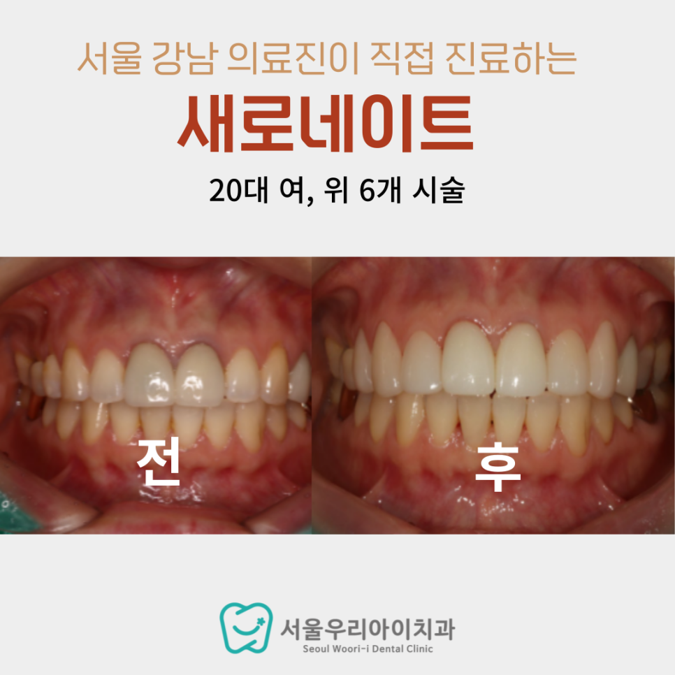 광주 앞니 두 개만 라미네이트 해도 인상이 바뀔 수 있습니다