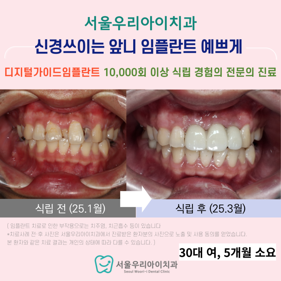 앞니 임플란트 잘하는 광산구 임플란트 치과에서 성공적인 앞니 임플란트