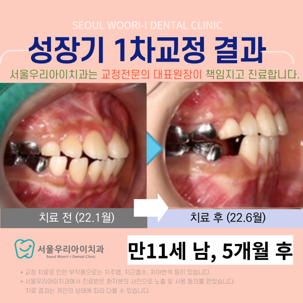 광주 1차교정 교정전문의가 직접 하는 치과 어디인가요?
