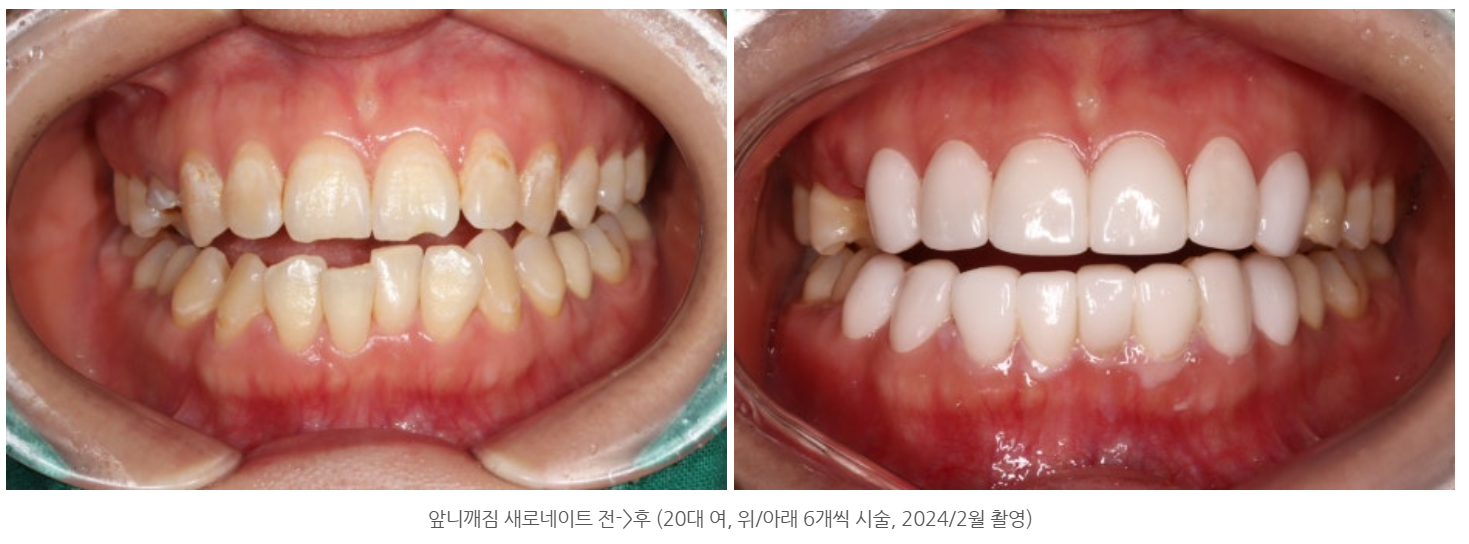 앞니 라미네이트 치아 삭제량은 얼마나 되나요? 앞니 깨짐도 해결...