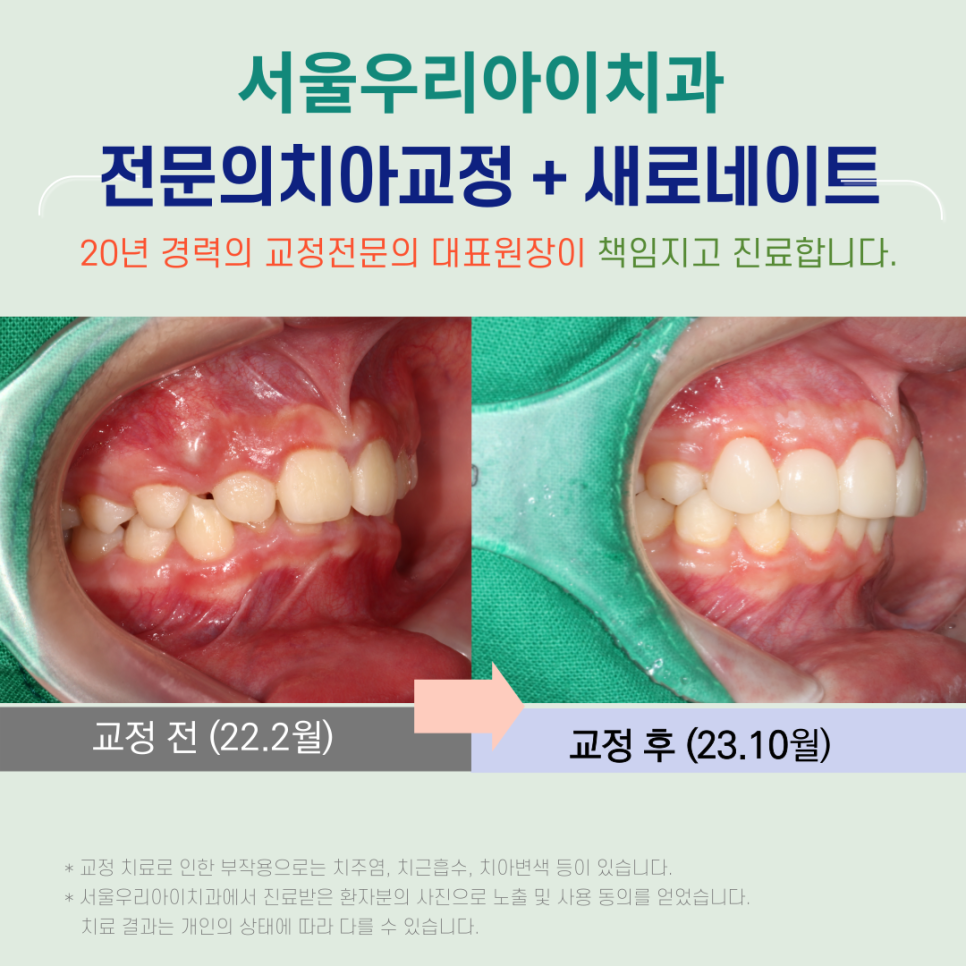 발치교정과 라미네이트를 전문의대표원장 협진시스템으로 전문의치아교...