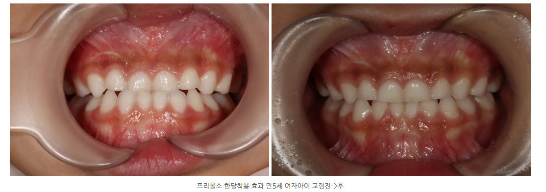 광산구치과 프리올소의 빠른 효과가 궁금하시다면?