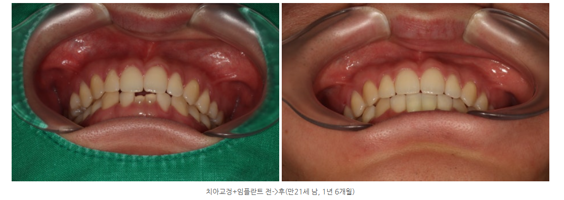 광주에서 치아교정하고 임플란트를 같이 하는 치과가 있나요?
