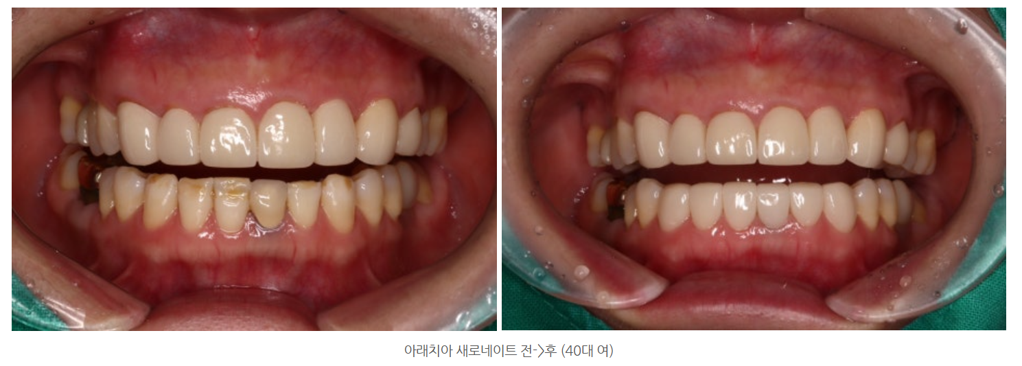 광주 라미네이트 치과에서 법랑질저형성 치아를 심미적으로 개선하는...