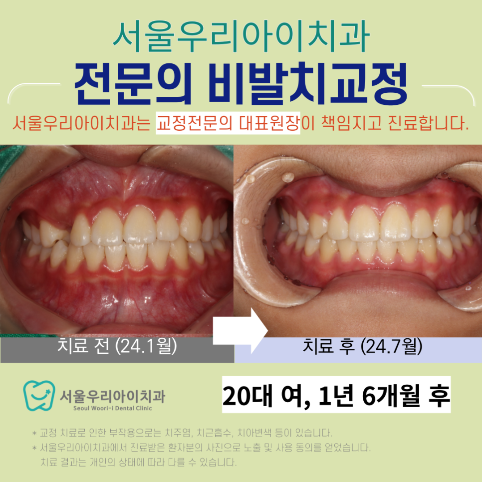 비발치교정의 장점은 무엇일까요? 광주 비발치교정 교정전문의 진료로