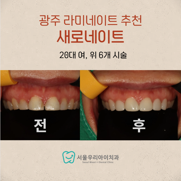 광주 무삭제 라미네이트가 가능한지 궁금한 대 이상이라면