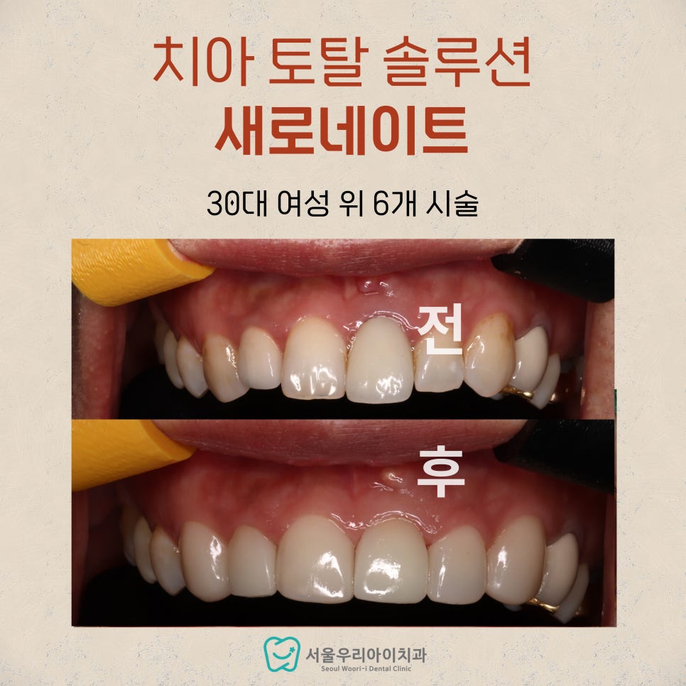 앞니끼리 색깔이 다를 때 해결법? 앞니가 까맣게 변색되었을 때...