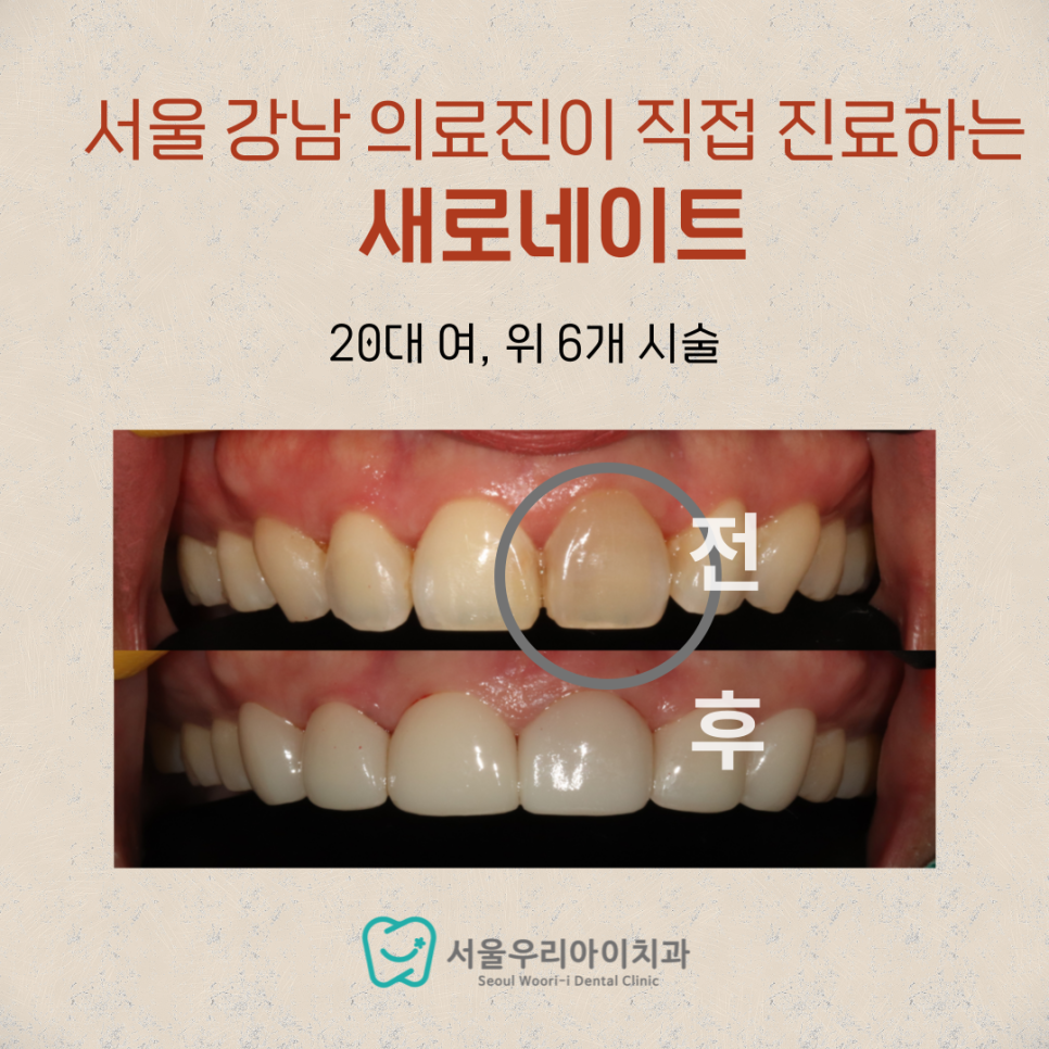앞니가 누렇거나 까맣게 변색돼 고민인 광주 20대 모여라!