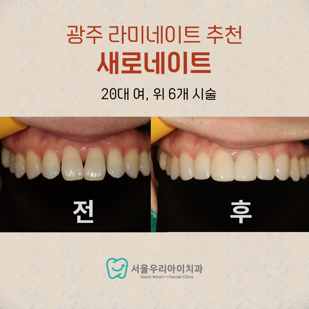 광주무삭제라미네이트 삭제량을 최소화한 완전히 새로운 새로네이트가...