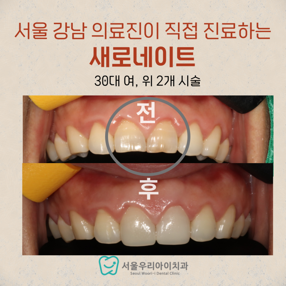앞니 라미네이트 최소 개수는 몇 개 일까요?