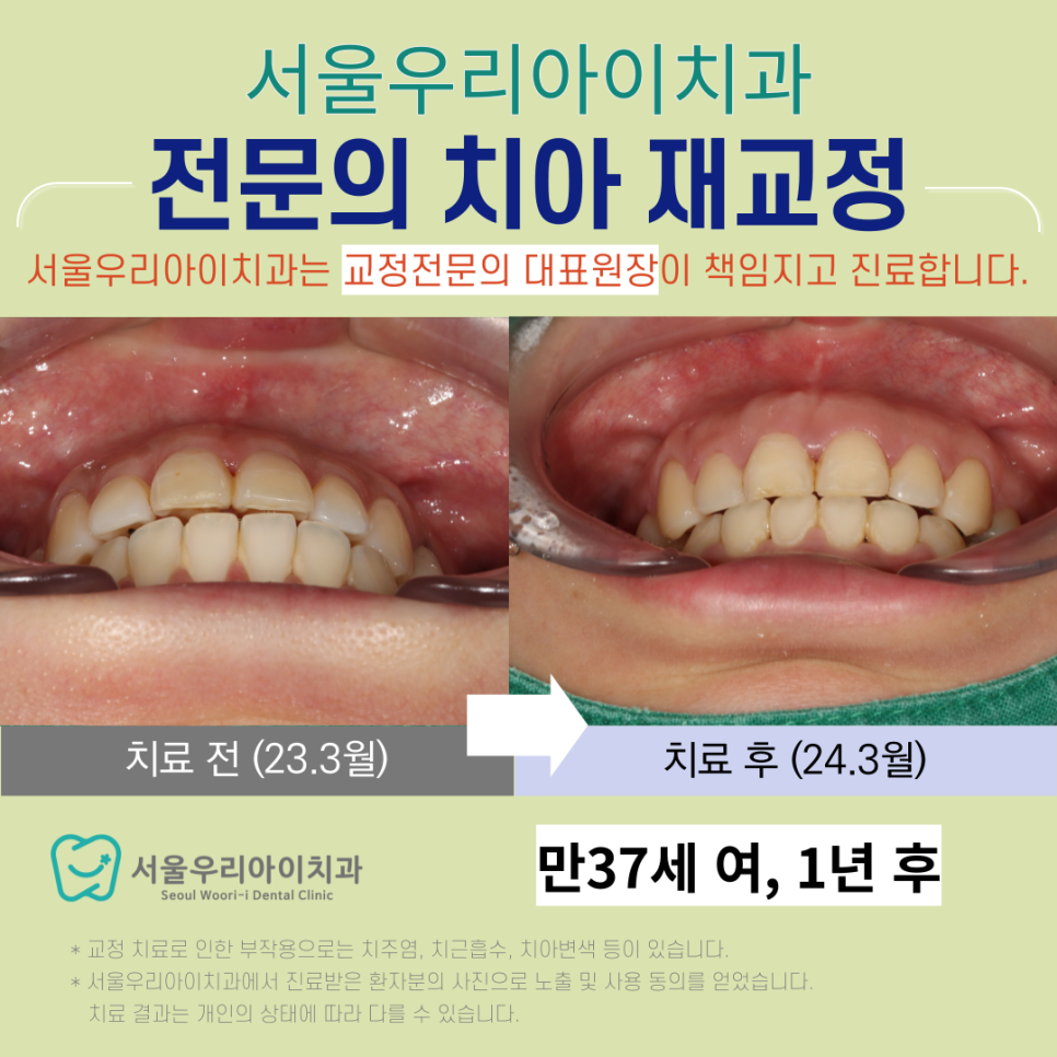 광주 치아 재교정 잘하는 곳 있나요?