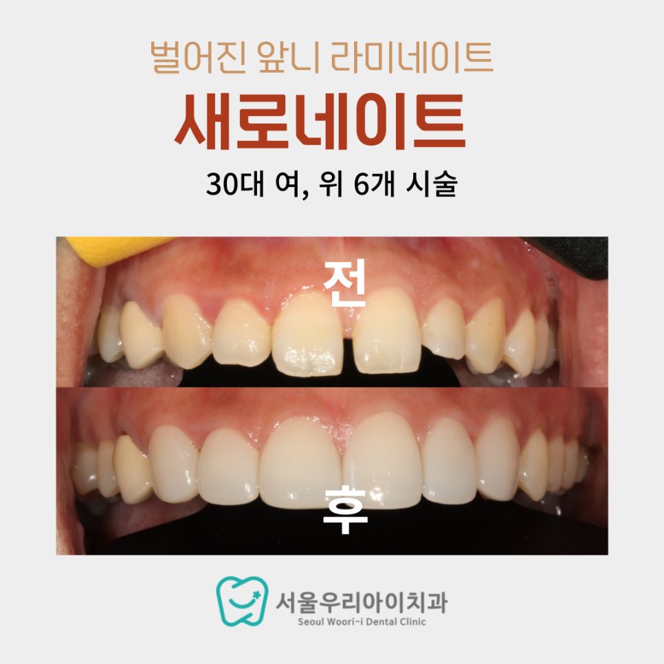 앞니가 벌어진 광주 30대 이상 여성이라면 놓치면 후회할 이야기는?