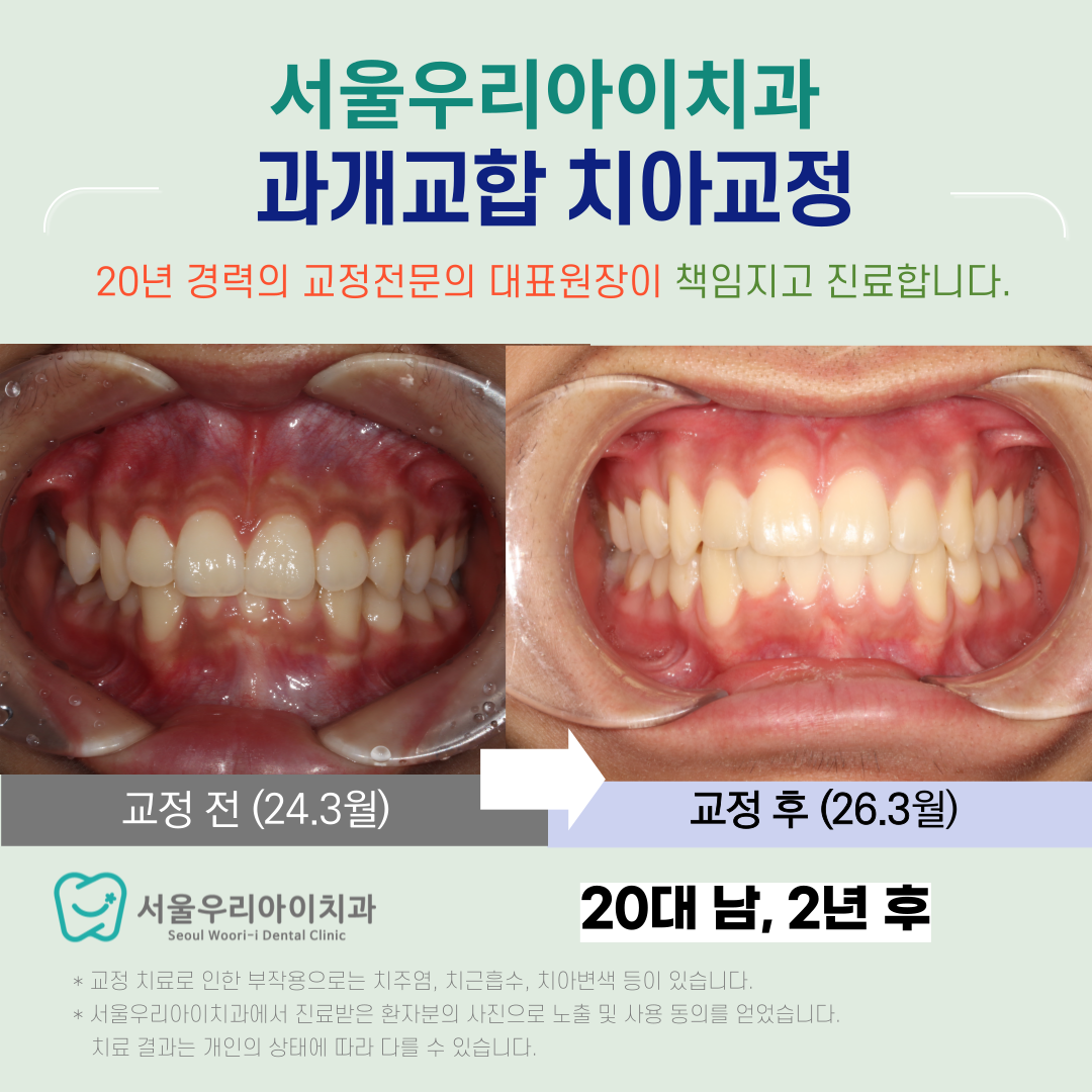 광주 성인 과개교합 교정전문의 대표원장 진료로 성공하는 비결은