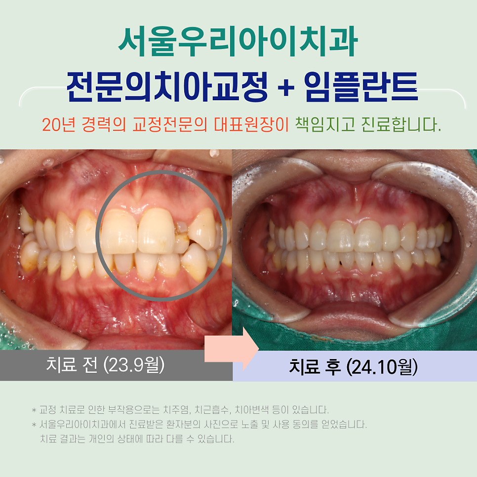 광주교정치과에서 임플란트도 가능한 치과가 있을까요?
