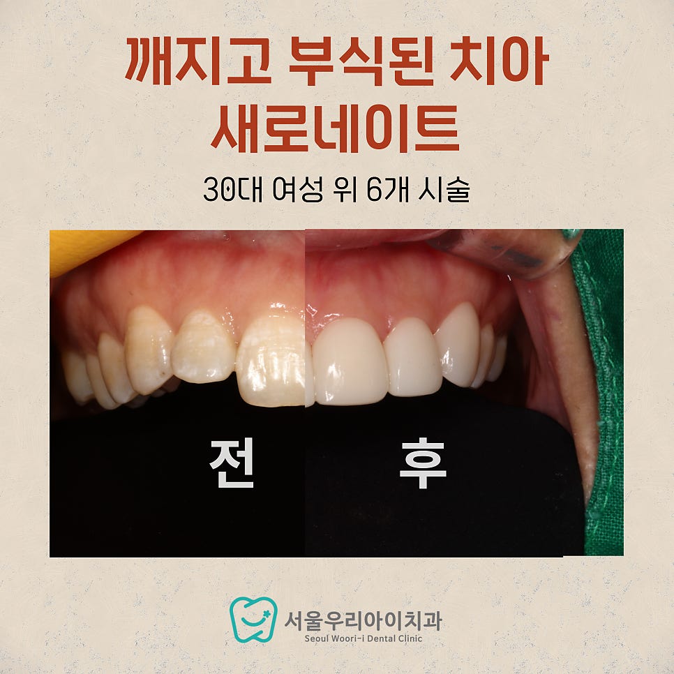앞니에 하얀 반점이 보여요. 해결방법은 무엇인가요?