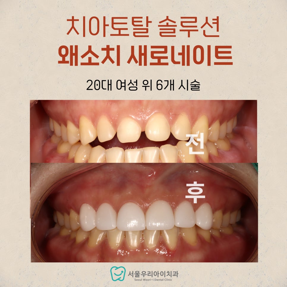 왜소치 치료법? 치아 크기가 다를 때 해결법? 앞니 크기 다를...
