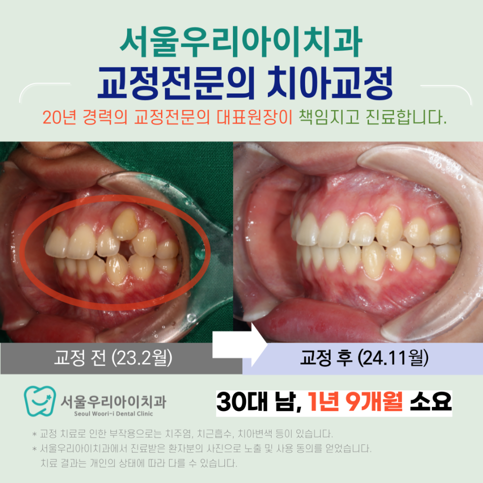 덧니 치아교정 잘하는 광주광역시 교정치과는?