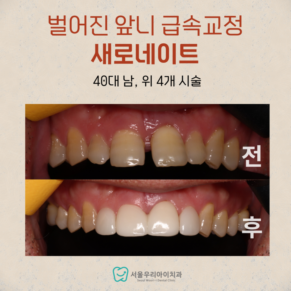 앞니 벌어진 것 때문에 스트레스라면 이걸 알아야 후회가 없습니다!