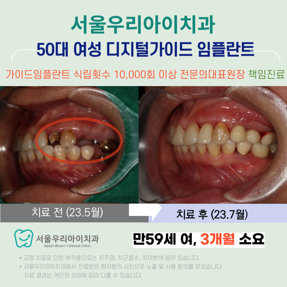 수완동 임플란트가 고민되는 분들에게 이것을 추천합니다.