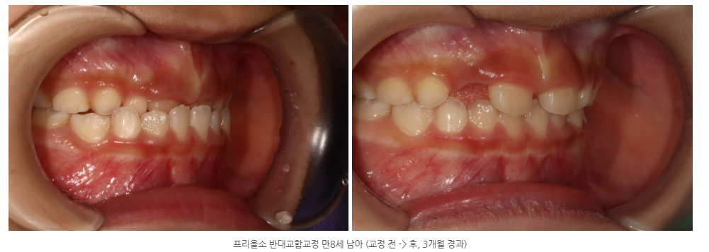 광주 반대교합 교정 교정전문의 치과에서 시작하세요