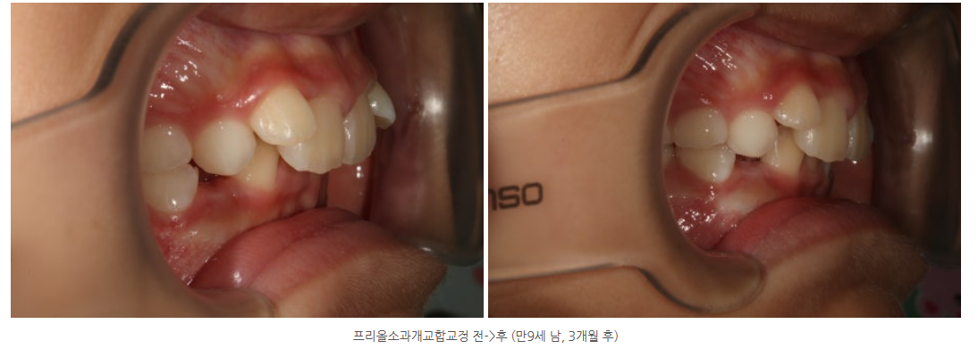 프리올소 과개교합 교정에는 어떤 타입의 장치가 필요한가요?