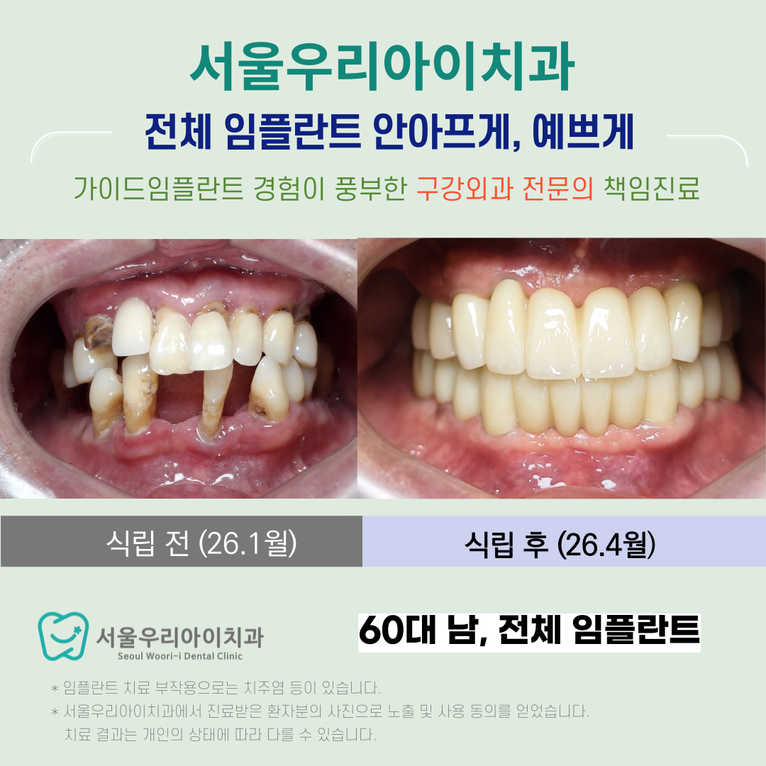 광주 전체 임플란트 전속자문치과에서 전문의 진료로 성공하는 비결...